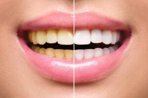 SKUTECZNE WYBIELANIE ZĘBÓW LAMPĄ