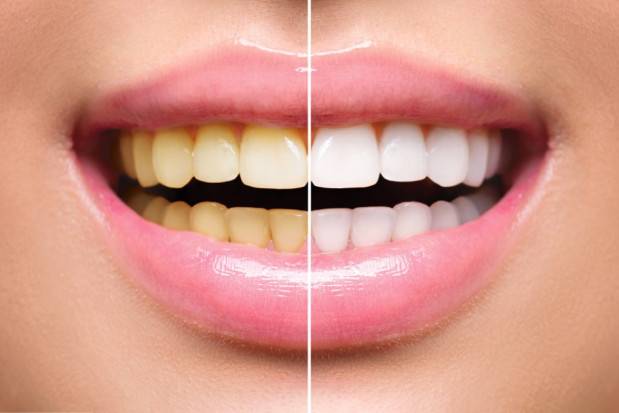 SKUTECZNE WYBIELANIE ZĘBÓW LAMPĄ